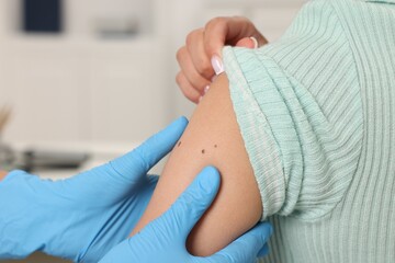 Obraz premium Doctor examining young woman's mole in hospital, closeup