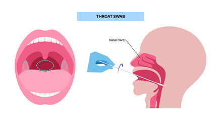 Swab throat procedure