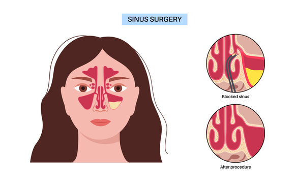 Functional Endoscopic Sinus Surgery
