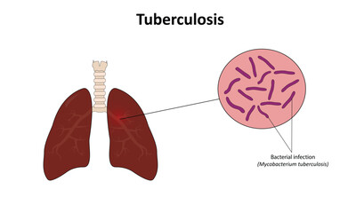 Obraz premium Tuberculosis vector illustration