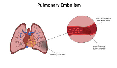 Obraz premium Pulmonary embolism vector illustration