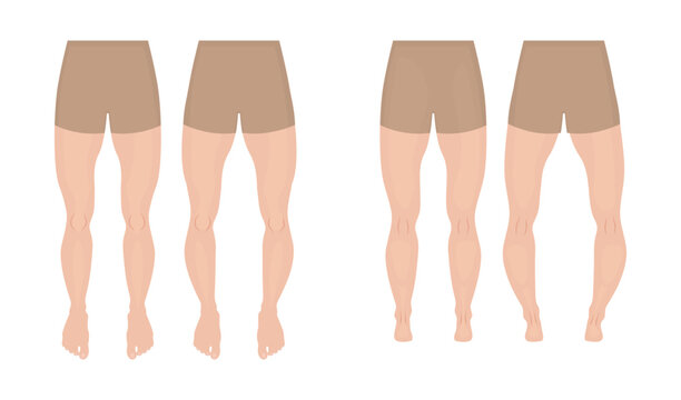 Normal legs and legs with genu varum and valgum, front and rear view