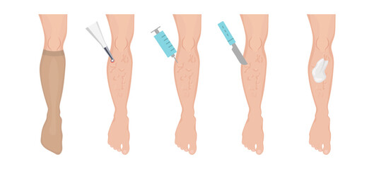 Doctor treating varicose veins with compression stocking, laser, injection, surgery and bandage