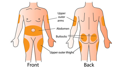Diabetes. Insulin injection sites shown on the male body: upper outer arms, abdomen, buttocks, upper outer thighs. Anatomical vector illustration in flat style isolated