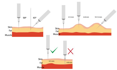 Insulin injection technique. Correct and incorrect way. Cross-section of skin structure. Flat vector illustration