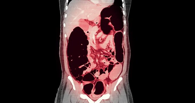 Innovative radiology imaging demonstrates by CT scan of abdomen showing gut obstruction, highlighting advanced radiology technology and accurate disease diagnosis in modern medical imaging.