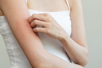 Dermatology, asian young woman reaction from atopic, insect bites on her arm, hand in scratching itchy red spot or rash of skin. Healthcare, treatment of beauty.