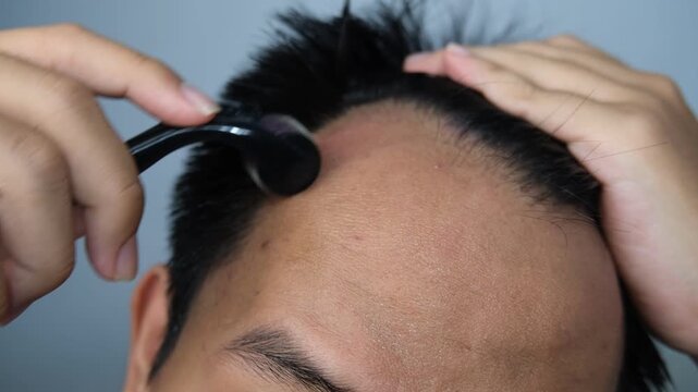 Close-up of a man applying a derma roller to his thinning hairline, commonly used to stimulate hair regrowth and scalp health.
