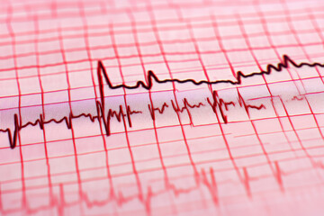 ECG electrocardiogram