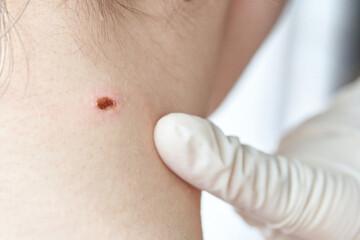 Close-up of gloved hand examining mole on caucasian adult neck for dermatology check.