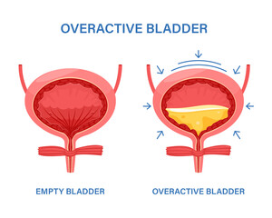 Overactive bladder, often leak anuria, bed wetting toilet urination, urge pass urine of pelvic. Floor muscle frequently, tract tumor, cancer, stroke.