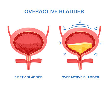 Overactive bladder, often leak anuria, bed wetting toilet urination, urge pass urine of pelvic. Floor muscle frequently, tract tumor, cancer, stroke.