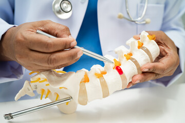 Doctor with lumbar vertebra bone skeleton and nerve model for treatment in the orthopedic...