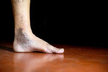 Close-Up of Varicose Veins on an Adult Human Foot With Skin Discoloration