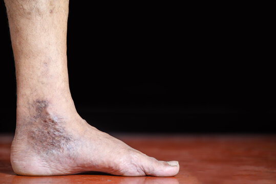 Close-Up of Varicose Veins on an Adult Human Foot With Skin Discoloration