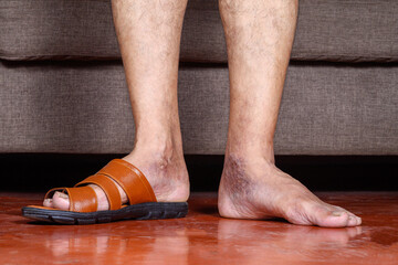 Close-Up of Male Legs with Visible Skin Conditions Wearing Sandals