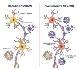 Alzheimers neuron diagram shows comparison of healthy and diseased neurons, highlighting amyloid plaques and neurofibrillary tangles, transparent background.