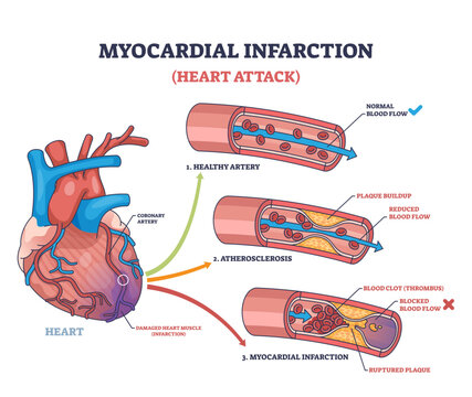 Myocardial infarction shows a heart with arteries, plaque buildup, and blood clot, illustrating heart attack causes, transparent background.