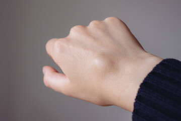 Female right back hand with ganglion cyst on the dorsum,  fluid-filled bump associated with a joint or tendon sheath, close-up view, selected focus.
