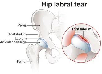 Hip labral tear. An injury to the cartilage (labrum) surrounding the hip socket. Labeled illustration © Axel Kock