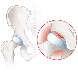 Hip labral tear. An injury to the cartilage (labrum) surrounding the hip socket. Labeled illustration