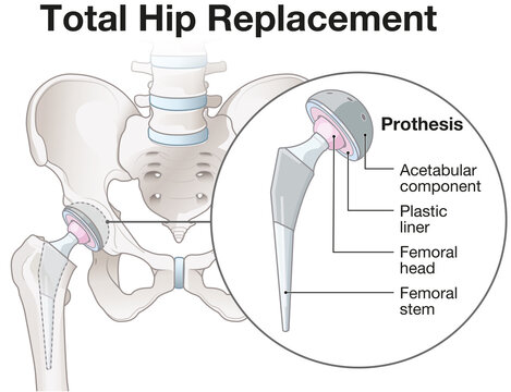 Total Hip Replacement &ndash; Medical Illustration of Hip Prosthesis