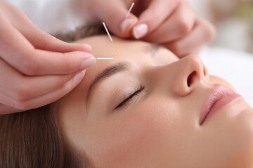 Cosmetic Acupuncture: Young Woman Undergoing Face Treatment with Acupuncture Therapy