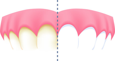 Upper teeth - Yellow (Before and After Comparison) illustration transparent design. Dental care concept.