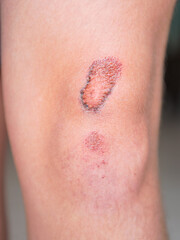 Fototapeta premium A wound on the body. Skin regeneration. Limb injury. Scratched knee.