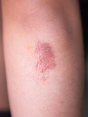 Fototapeta premium A person has a red mark on their arm. The mark is small and red, and it is located on the inside of the arm