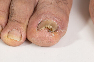 Ingrown toenail on a senior feet with white background
Close-up ingrown toenail on senior feet with white background.