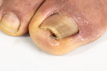Fototapeta premium Ingrown toenail on a senior feet with white background Close-up ingrown toenail on senior feet with white background.