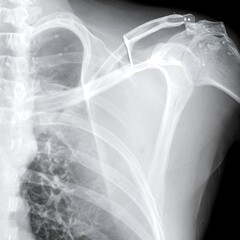 Obraz premium Shoulder X-ray showing fracture repair