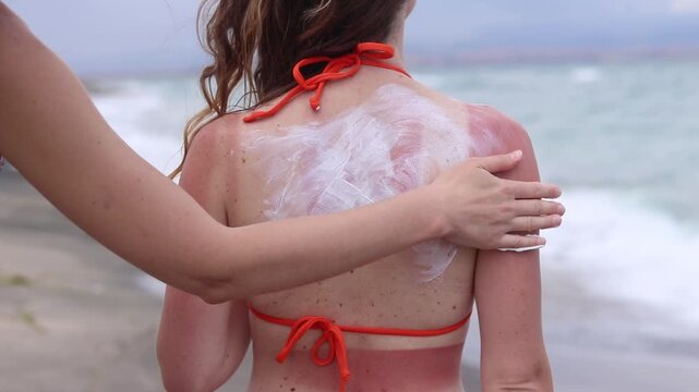Close-up of applying sunscreen to skin. SPF protection. One girl helps another apply sunscreen to skin on back. Tanning according to clothing. Woman in swimsuit