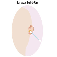 Vector showing earwax build-up with symptoms like blockage, reduced hearing, itching, discomfort; includes similar conditions such as otitis externa and foreign body obstruction. silhouette