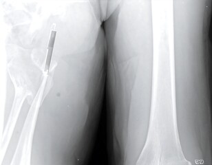 Hip and leg x-ray showing implant
