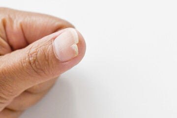 Thumb torn nail on white. Healthcare and medical concept.