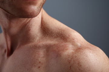 Naklejka premium Man shoulder with folliculitis skin condition showing red bumps and irritation on medium tone skin under soft lighting, close up view of upper body and neck area