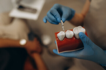 Dentist showing implant placement using teeth model