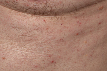 Macro image of irritated male skin on the neck, showing hair follicles, blemishes, and dermatological imperfections. Ideal for use in skincare, dermatology, educational, or health-related visuals