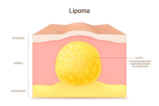 Lipoma. Benign tumor of fat tissue. Adipose tumor. Skin problems.