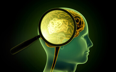 Magnifying glass finding brain tumor, brain cancer. 3d illustration