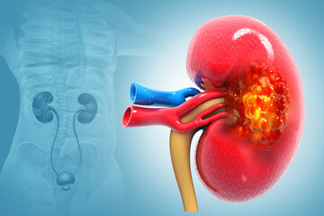 Diseased human kidney. kidney cancer. 3d illustration