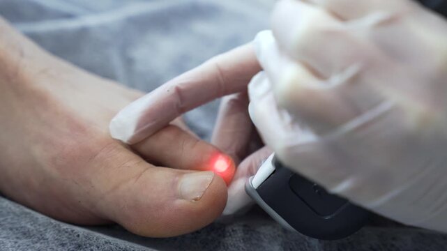Close up woman doctor doing laser treatment procedure for toenail fungus. Fungal infection on the nails.