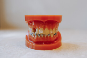 This detailed dental model with braces is designed for educational and training purposes