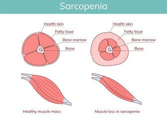 Sarcopenia. Loss of muscle mass.Vector anatomical illustration