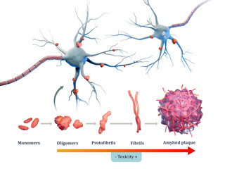 Amyloid plaques formation in Alzheimer disease