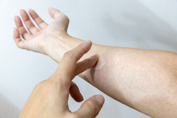 汗疹に塗り薬を塗っている