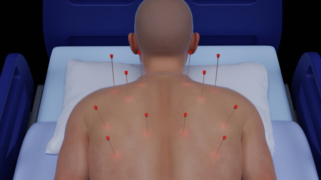 3D Illustration of Dry Needling Physiotherapy. Acupuncture Therapy on Upper Back for Pain Relief. Medical Treatment Using Dry Needling 3D Render. Dry Needling Therapy for Muscle Relaxation