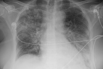 Human lungs with COVID-19 pneumonia, chest X-ray showing bilateral lung infiltrates with...